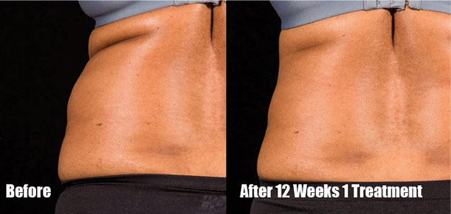 sculpsurebeforeafter1