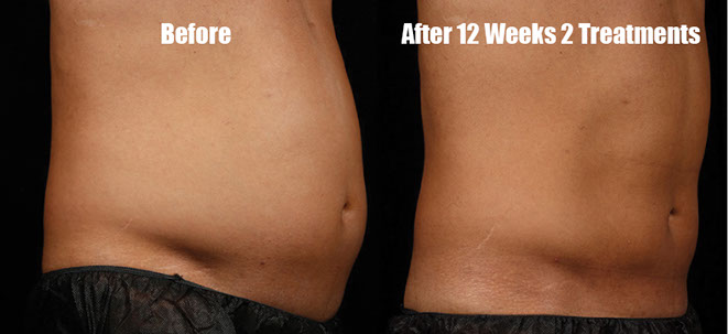 sculpsurebeforeafter2